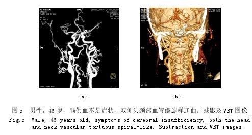 血管造影在头颈部血管病变中的临床