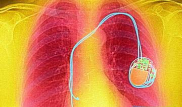 技术前瞻:光控心脏起搏器的未来